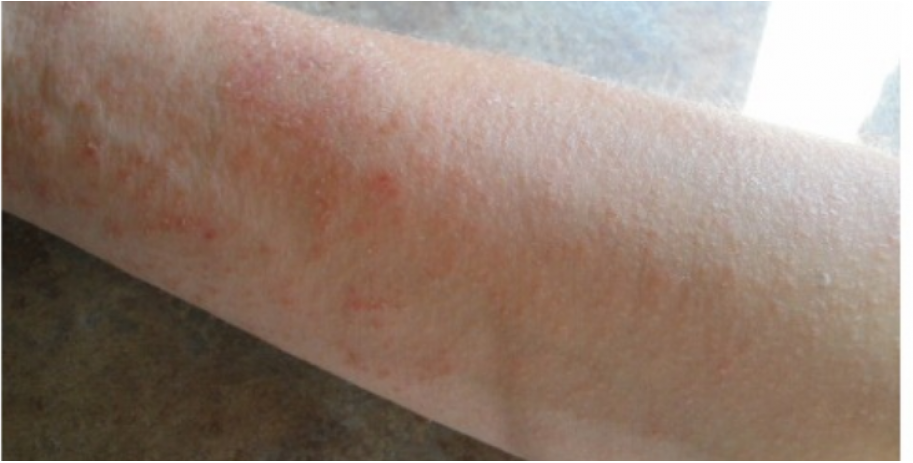 Do you know, yeast overgrowth can cause this Itchy rash?